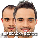 hair-transplant