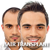 hair-transplant